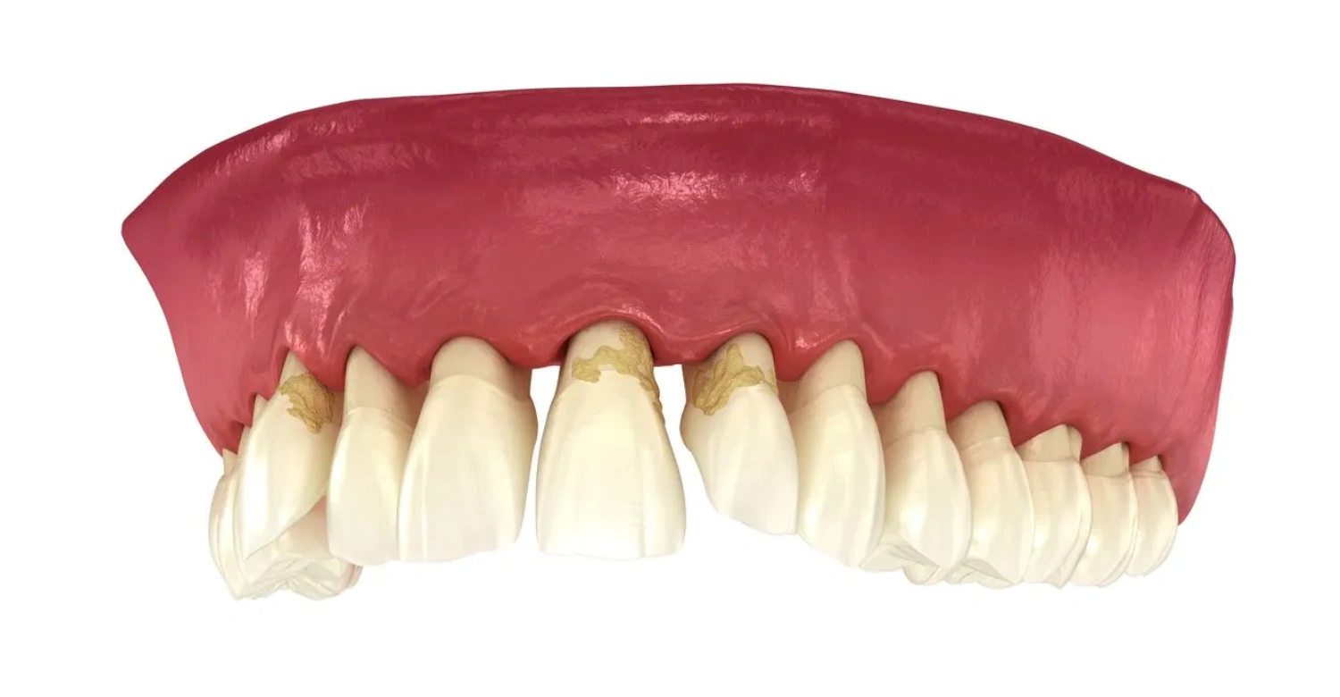 What does periodontal disease look like Inblog